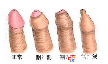 切包皮什么技術好_九江醫大醫院
