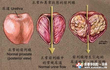 前列腺增生出現血尿怎么辦？—九江醫大醫院