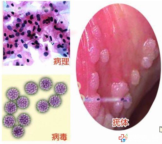 防復發是治愈尖銳濕疣的關鍵