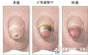 包皮過長也有“真假”之分