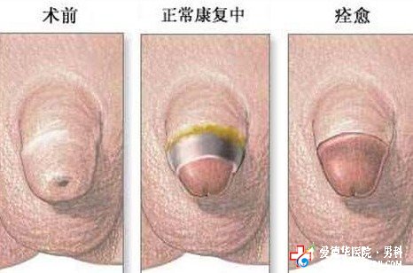 包皮過長對性功能有影響嗎