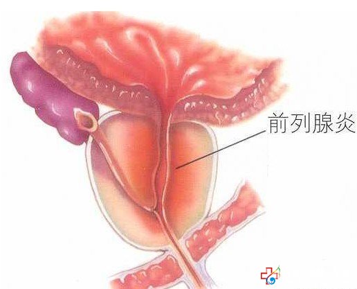 引起細菌性前列腺炎反復發(fā)作的原因