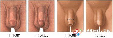  九江包皮手術價格貴嗎