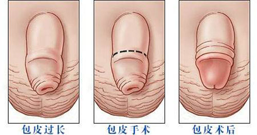 包皮怎樣過長
